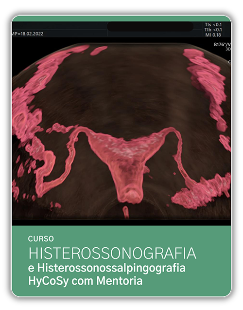 CM US HYCY - Curso Histerossonografia e Histerossonossalpingografia (HyCoSy) com mentoria